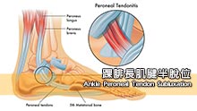 踝腓長肌腱半脫位Ankle Peroneal Tendon Subluxation