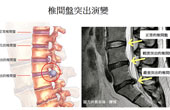 腰、頸椎間盤突出 (手腳麻痺)