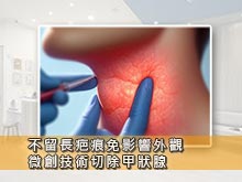 不留長疤痕免影響外觀 微創技術切除甲狀腺