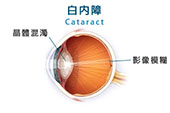 白內障不需等熟透才可做手術