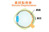 治療黃斑點病變預防是最好方法