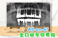 All-on-4? All-on-6? 全口植牙你要知 Part1
