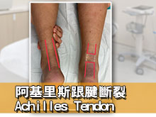 阿基里斯跟腱Achilles Tendon斷裂