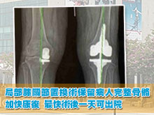 局部膝關節置換術保留病人完整骨骼加快康復　最快術後一天可出院