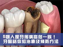 5類人是牙周病高危一族！ 牙醫話你知治療及預防方法