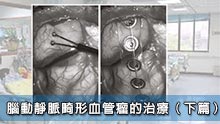 腦動靜脈畸形血管瘤的治療（下篇）