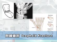 舟骨骨折 Scaphoid Fracture