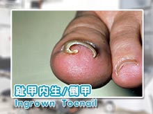 趾甲內生/倒甲 Ingrown Toenail