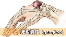 腱鞘囊腫 (ganglion)