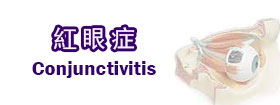 紅眼症conjunctivitis