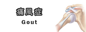 痛風症Gout