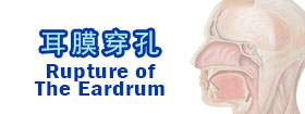 耳膜穿孔Rupture of the Eardrum