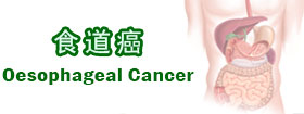 食道癌Oesophageal Cancer