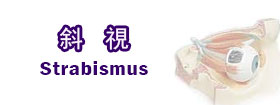 斜視Strabismus