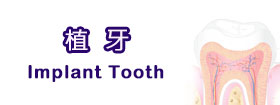植牙Implant Tooth