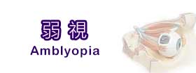 弱視Amblyopia