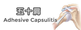 五十肩Adhesive Capsulitis