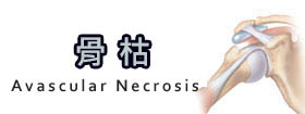 骨枯Avascular Necrosis