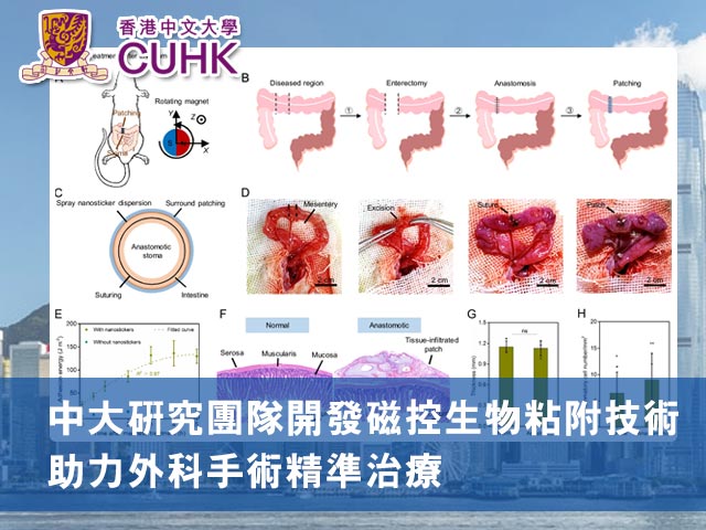 中大研究團隊開發磁控生物粘附技術 助力外科手術精準治療