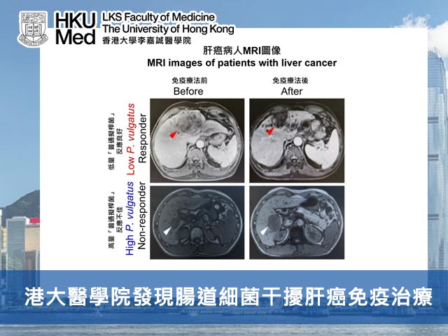 港大醫學院發現腸道細菌干擾肝癌免疫治療