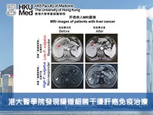 港大醫學院發現腸道細菌干擾肝癌免疫治療