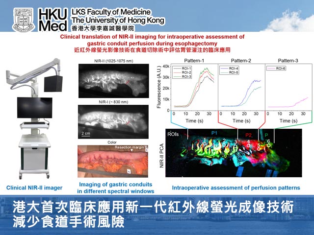 港大首次臨床應用新一代紅外線螢光成像技術，減少食道手術風險